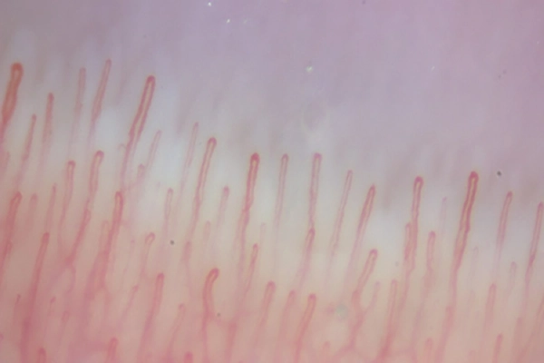 τριχοειδοσκόπηση